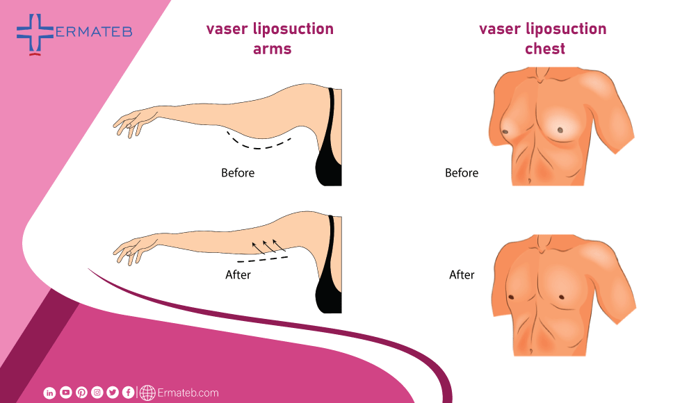 vaser liposuction of arms and chest